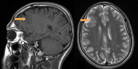 Frontal Lobe Epilepsy Causes, Symptoms, Diagnosis and Treatment ...