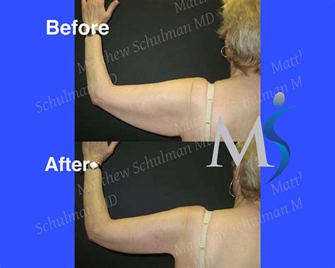 Brachioplasty Or Arm Lift Antony Fitton Plastic Surgery