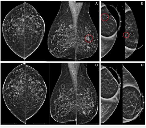 Surveillance Mammograms For An Asymptomatic 68 Year Old Patient With A