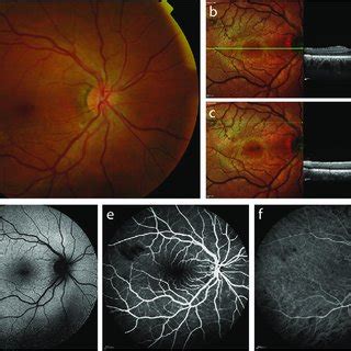 Multimodal Imaging Of The Right Eye Of A Patient With Infectious