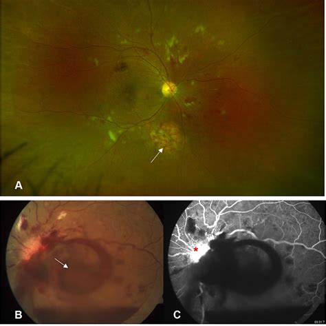 Radiation Retinopathy Detection And Management Strategies Opth