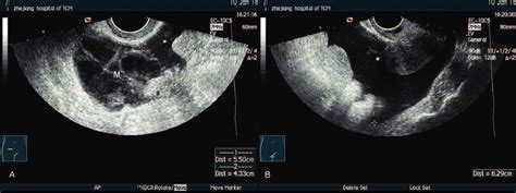 (A) Sagittal ultrasound image showing the complex adnexal mass (M),... | Download Scientific Diagram