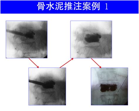 手把手教学：椎体成形术操作规范，一文掌握！ 德医学院 助力医学教育发展！