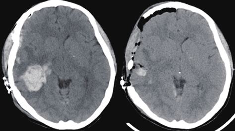 Head CT scan at rebleeding on day 2. Head CT scan on the second day of ...