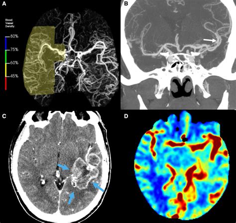 Automated Detection Of Intracranial Large Vessel Occlusions On Computed