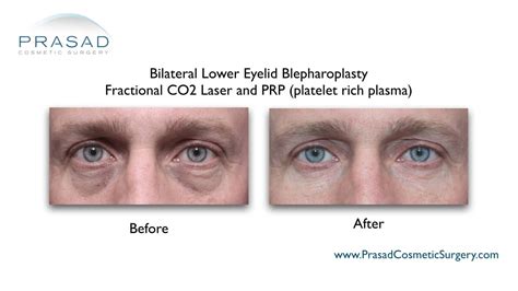 Benefits Of Prp Injection Under Eyes Dr Prasad New York