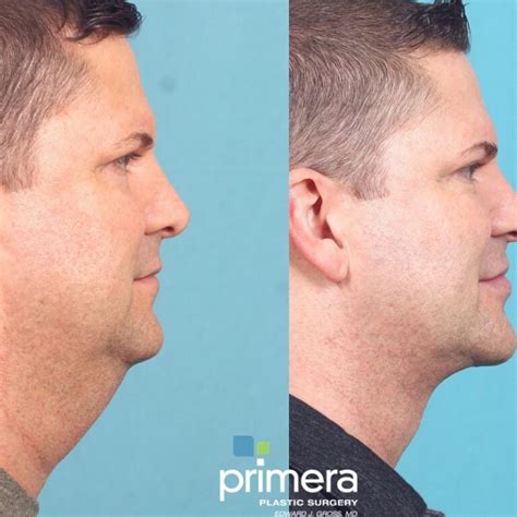 Buccal Fat Removal Before And After What You Need To Know Must Read This Before Buying