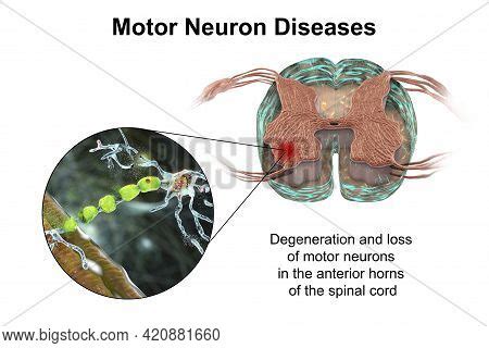 Motor Neuron Diseases Image Photo Free Trial Bigstock