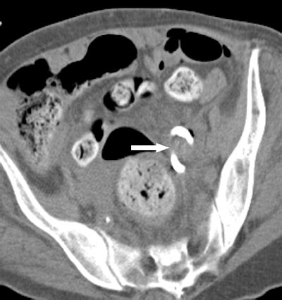 Removal Of Abscess Drainage Catheter Cpt Code