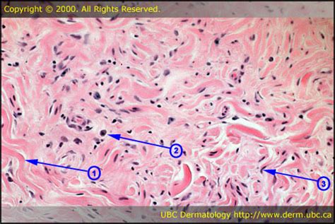 Neurofibroma Histology