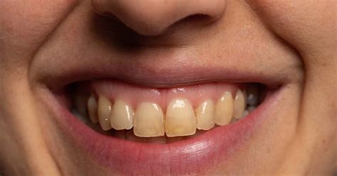 Causes Of Stained Or Yellow Teeth Call 214 613 1500 To Improve Your Smile