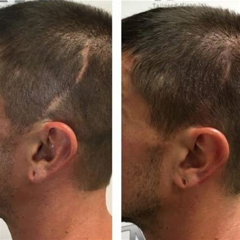 Prf Hair Restoration Drew Co Medical Aesthetics