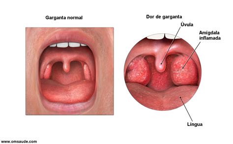 Amígdalas Inchadas O Que Pode Ser