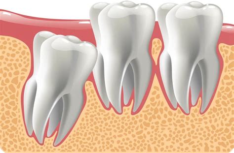 Dents De Sagesse Clinique Dentaire Dr Eric Lajoie