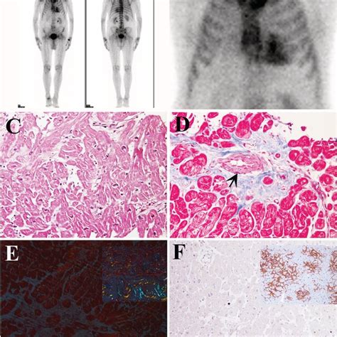 Bone Scintigraphy And Lv Endomyocardial Biopsy Findings A B Whole