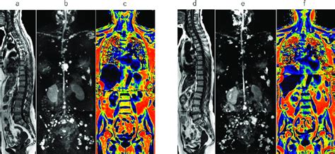 Whole Body Mri With A Focal Dominant Pattern Sagittal T1 Weighted