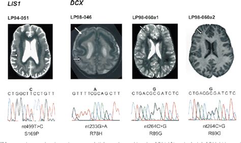 Figure From Subcortical Band Heterotopia In Rare Affected Males Can