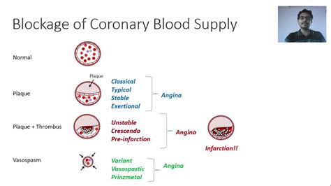 Angina Pectoris Types Pathophysiology And Management Principles