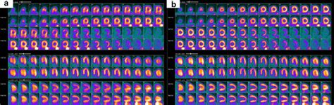 Data Driven Motion Correction Ddmc A Before B After Motion