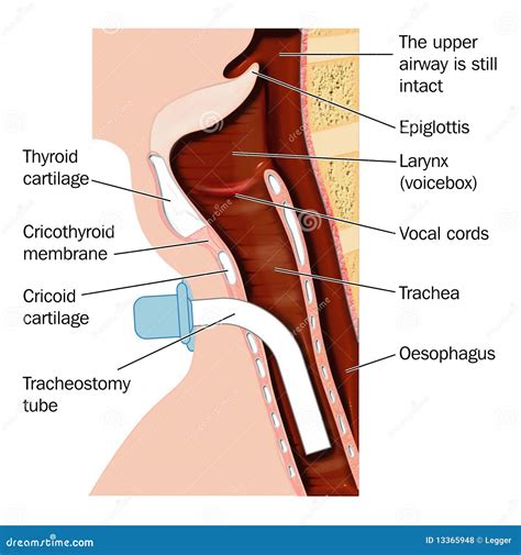 Tracheostomy Tube Placement Stock Vector Illustration Of Epiglottis