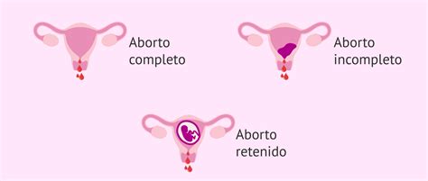 Tipos de abortos espontáneos según la variedad clínica