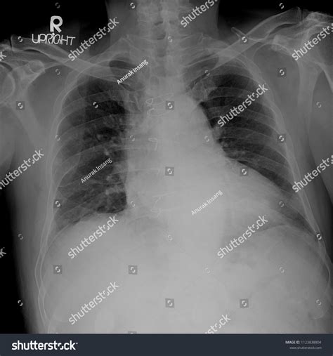 Coronary Stents On Chest Xray Stock Photo Edit Now 1123838804