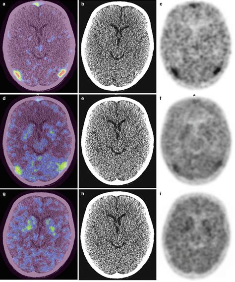 Positron Emission Tomography PET Radiology Key