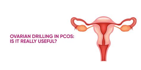 Ovarian Drilling In PCOS Is It Really Useful