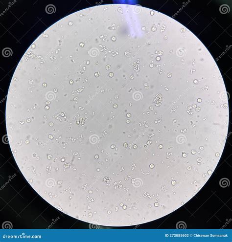 Protein And White Blood Cells In Urine But No Infection at Neal Marquez