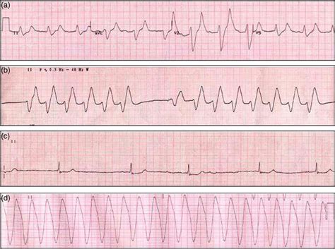 Sine Wave Hyperkalemia Ecg Changes