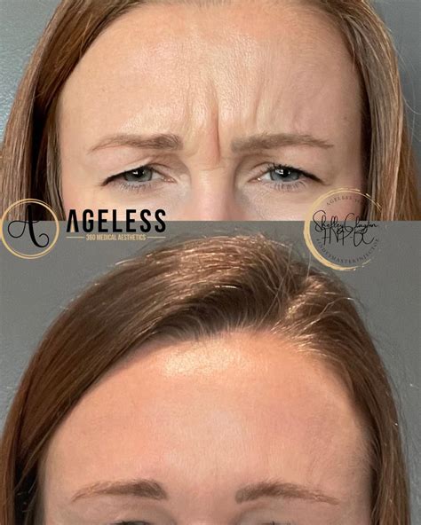 Neurotoxins And Dermal Fillers • Indianapolis In • Ageless Aesthetics