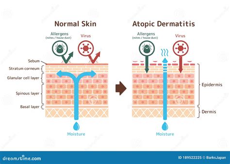 Sectional View Of Atopic Dermatitis And Normal Skin Comparative