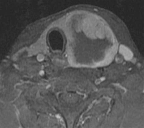 Anaplastic thyroid cancer MRI - wikidoc