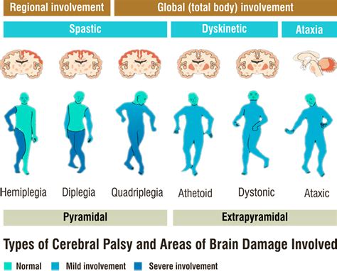 Quadriplegia Tetraplegia Definition Causes Symptoms