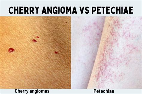 Cherry Angioma vs. Petechiae: What's the Difference?