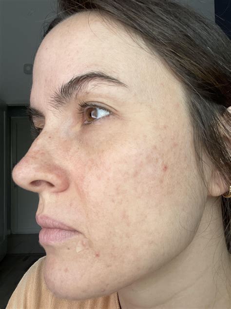 One Month In On 45 Tret Rtretinoin