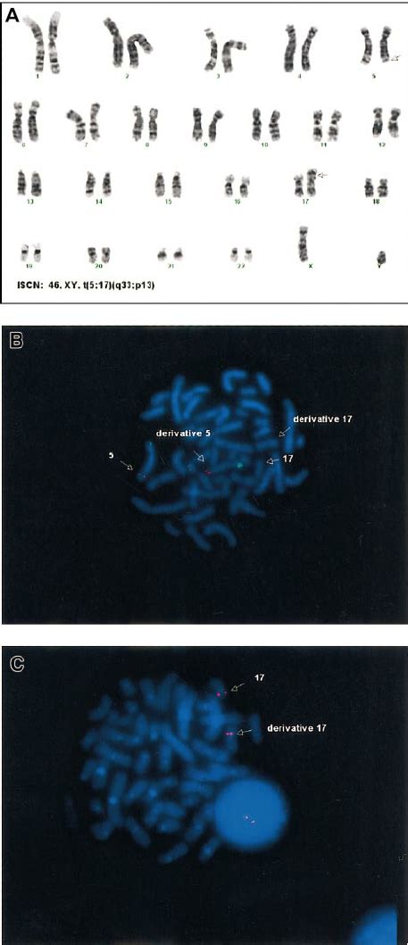 Cytogenetic Analyses A G Banded Karyotype From Bone Marrow Showing