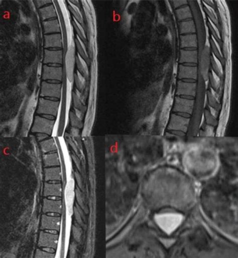 Figure 1 From Pure Thoracic Spinal Epidural Cavernous Hemangioma Sech