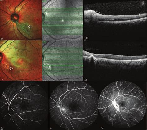 A Case Of Left Eye Toxoplasma Retinochoroiditis A Multicolor Image