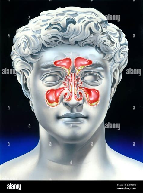 Sinusitis Illustration Of A Frontal Section Through The Nasal Cavities