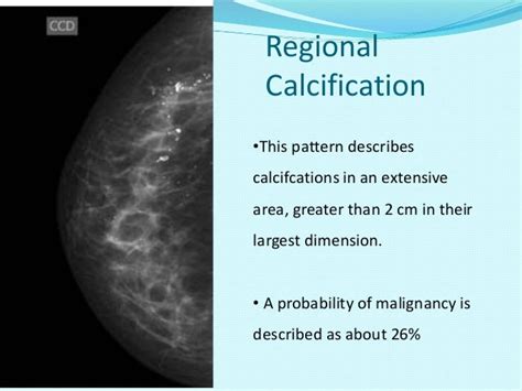 Microcalcifications In Carcinoma Breast