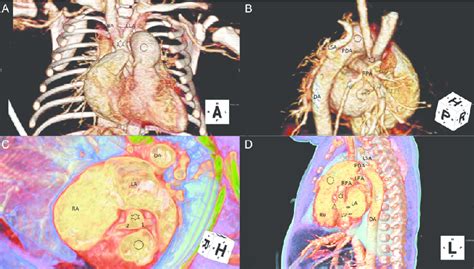 A Day Old Boy With Interrupted Aortic Arch Type B And Bicuspid Aortic