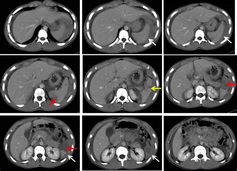 Grade Ii Spleen Injury Radiology Cases