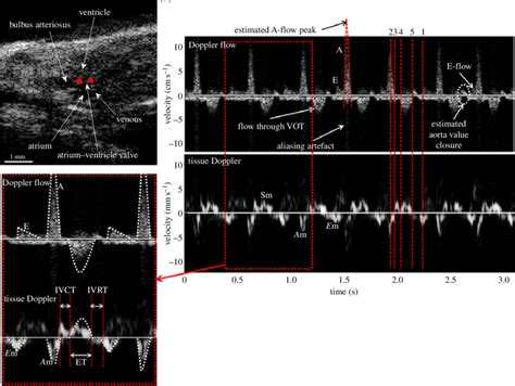 B Mode Image And Doppler Waveforms Acquired With The Dual Mode Pwd From