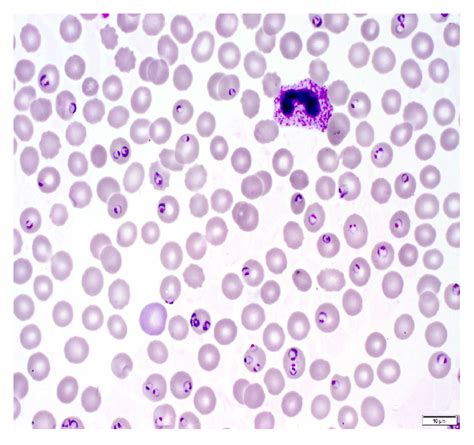 Positive Blood Smear For Malaria Hot Sex Picture