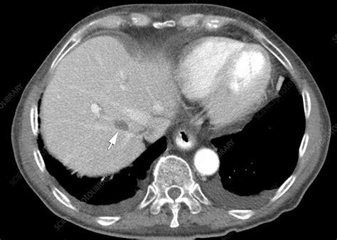 Gastrointestinal Stromal Tumour Ct Scan Stock Image C