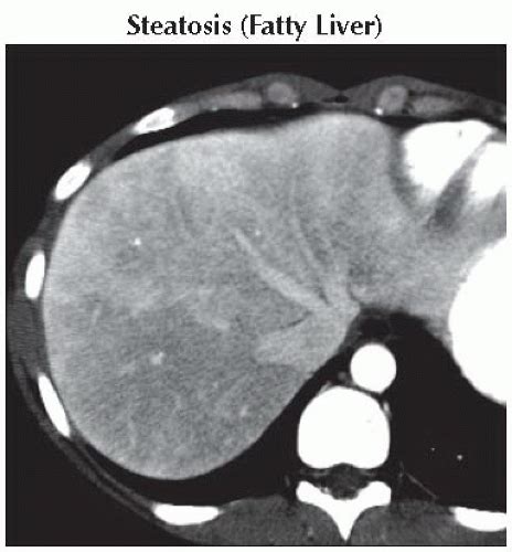 Da Db Widespread Low Attenuation Within Liver Ffu Abdominal Key