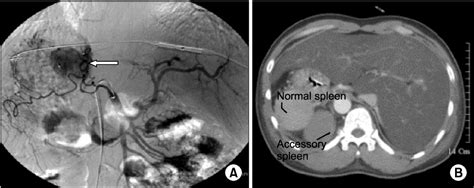 Figure 3 From Gastric Bleeding Arisen In A Patient With Situs Inversus