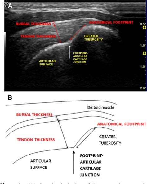 Rotator Cuff Ultrasound