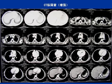 肺部常见疾病ct读片word文档在线阅读与下载无忧文档